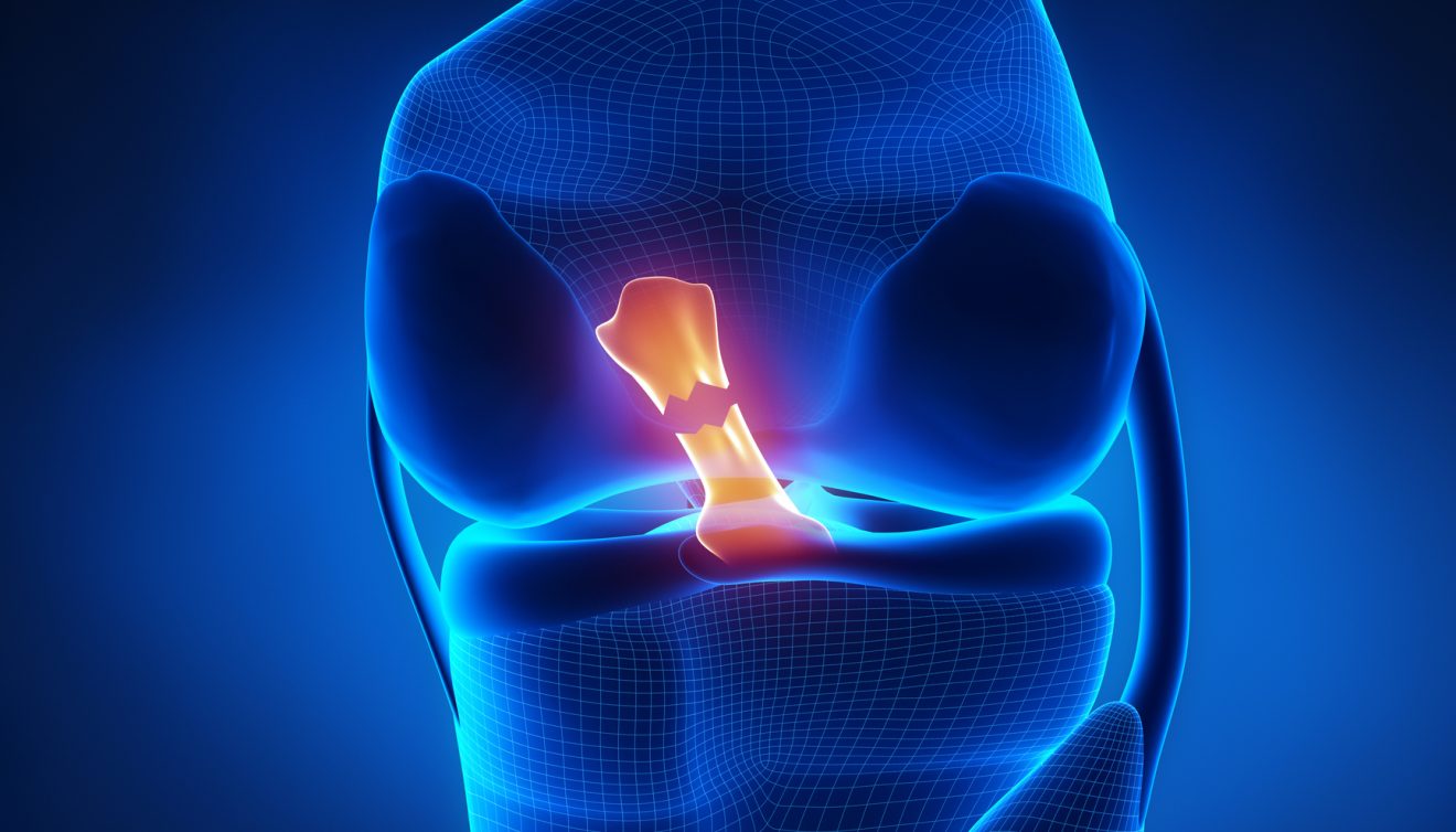 Kishore Receives Second NIH Grant to Advance Groundbreaking ACL Reconstruction Research