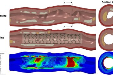 ASME Honors Florida Tech Researchers for Stenting Safety Study