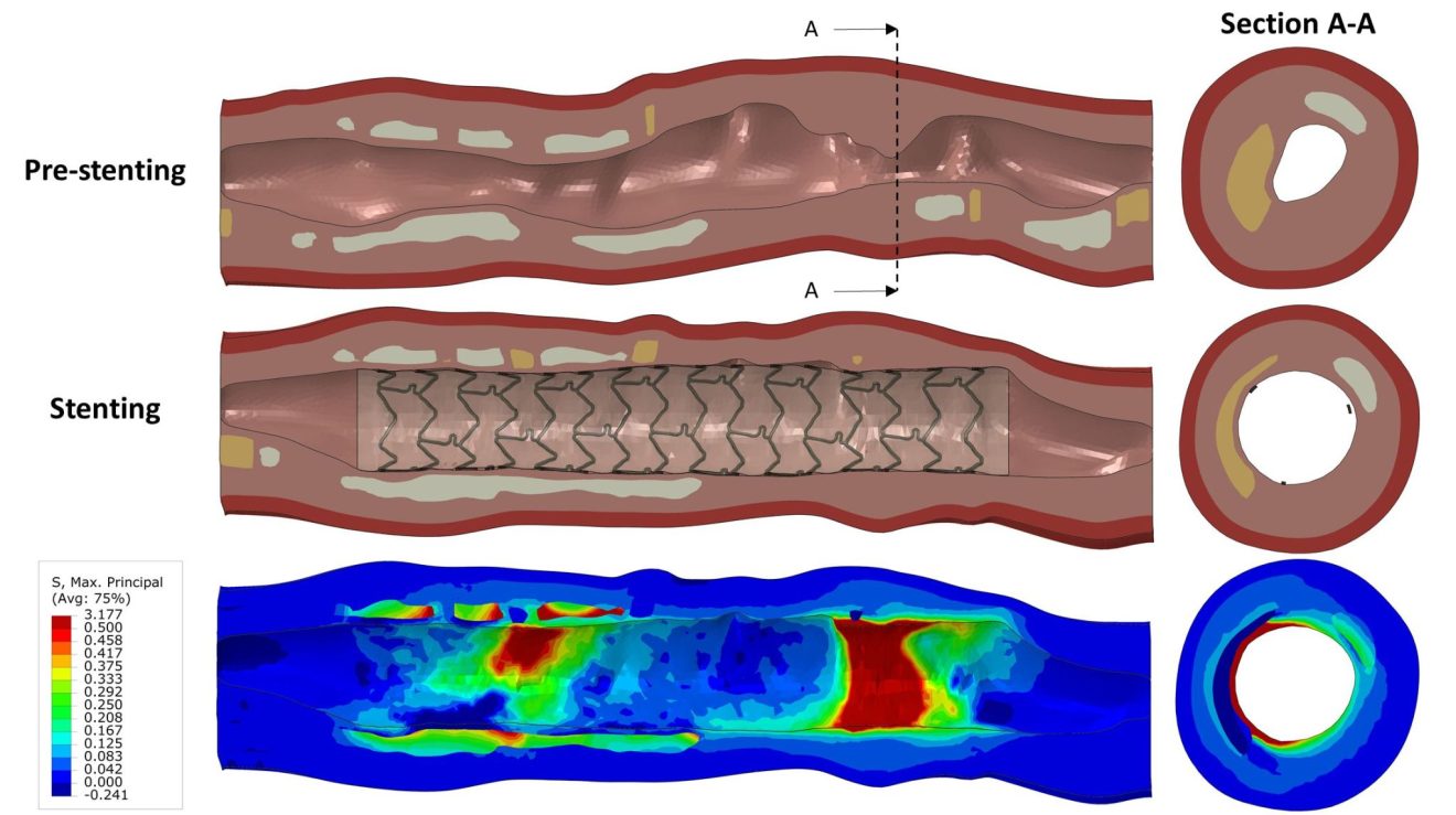 ASME Honors Florida Tech Researchers for Stenting Safety Study